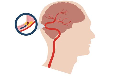 Dấu hiệu nhận biết cơn thiếu máu não thoáng qua