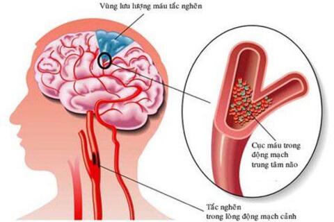 Phòng Ngừa Đột Quỵ Do Xơ Vữa Động Mạch